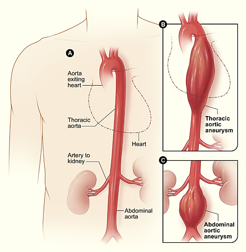 Aortic_aneurysm