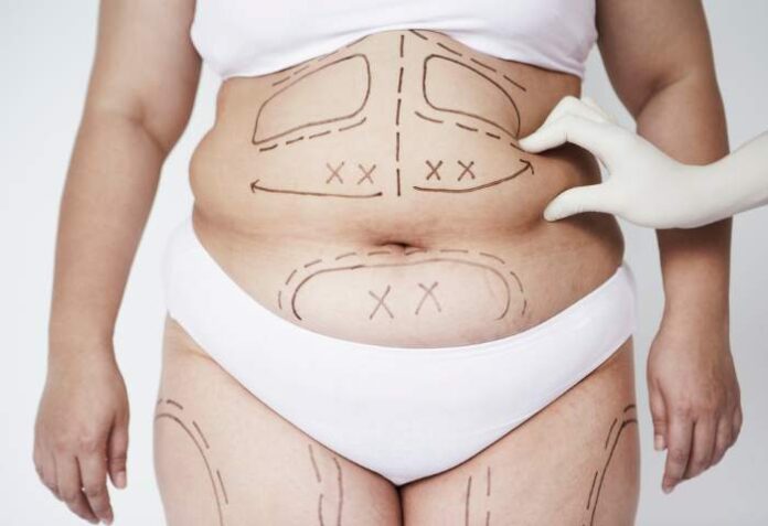 how much does liposuction cost in florida